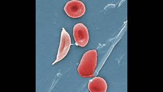 Sickle Cell Disease in the ED [upl. by Barnie295]