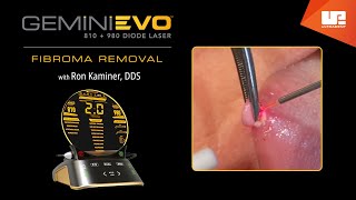 Fibroma Removal  Gemini EVO™ clinical cases [upl. by Eintruok981]