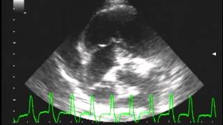 multifocal Ventricular Tachycardia with Right Atrial mass [upl. by Genie]