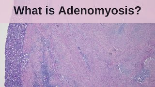 What is Adenomyosis  Pathology mini tutorial [upl. by Yeznil]