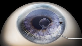 DMEK Descemets membrane endothelial keratoplasty animation [upl. by Seiden]