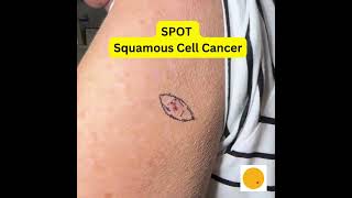 Squamous Cell Carcinoma arm Spot Skin Cancers [upl. by Jonah]