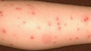 How to get rid of bed bug bites [upl. by Daniella112]