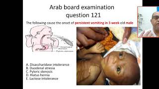 MCQ 121 how to approach for CHIPS pyloric stenosis string sign hypokalemic metabolic alkalosis [upl. by Billi]