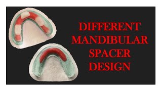 MANDIBULAR SPACER DESIGNS  SPACER DESIGN  Prosthodontics  Dental Education by DENTALCAFE [upl. by Summers]