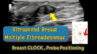 Breast Multiple Fibroadenomas  Positioning according to Breast Clock  Ultrasound [upl. by Ivetts369]