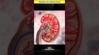 Kidney mein stone ka ilaj [upl. by Aliahs]