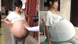 Una Mujer Con Barriga Gigante Que Pesa 19 Kilos Y Sigue Creciendo [upl. by Elaina357]