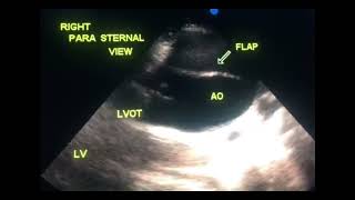 Asymptomatic dissection of aorta to drahmadmirdamadisiJSbA7GCDIDSLEpD [upl. by Cailly728]