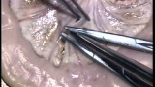 Mesenteric Vessel Ligation Basic Surgical skills series [upl. by Pilif]