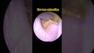 Check out this ear wax removal 😊Super satisfying [upl. by Cummings]