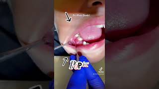 pop It  Dental abscess [upl. by Werdnaed464]