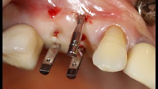 Flapless Surgery using Pin Guide kit [upl. by Memberg]