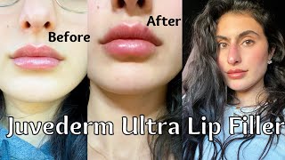 JUVEDERM ULTRA LIP FILLER 1 SYRINGE my experience  healing process [upl. by Dietsche]