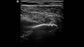 Chest Ultrasound 6th Costochondral Margin Arch Injection [upl. by Attenahs]