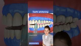 Teeth whiteningTeeth Bleaching Whiter Teeth shorts viralvideo dental trending teethwhitening [upl. by Sinnej]