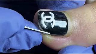 DIY Ingrown Toenail Removal  How to Safely Cut Ingrown Toenails at Home [upl. by Llerej800]