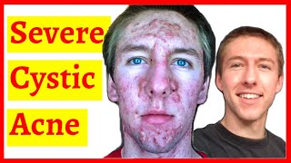 Cystic Acne Skin Clearing Transformation  10 Month Timelapse [upl. by Anette667]