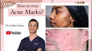 Acne Marks treatment  Acne treatment Dermatologist  Lasers and peels  Dr Ankur [upl. by Eikciv]