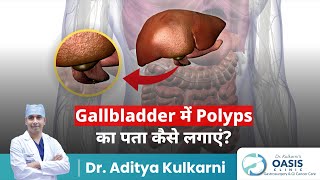 Gallbladder में Polyps का पता कैसे लगाएं  Dr Aditya Kulkari [upl. by Eillek]