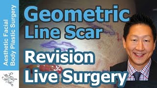 Live Surgical Scar Revision with a Geometric Line Closure Get the Best Results with Scar Treatment [upl. by Conlon]