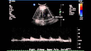 Duplex Demonstration of Normal Renal Arterial Blood Flow  Case Study [upl. by Ethben]