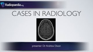 Cases in Radiology Episode 1 neuroradiology CT MRI [upl. by Anegue776]