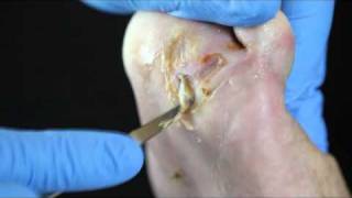 Debridement of a diabetic foot ulcer [upl. by Helbona64]