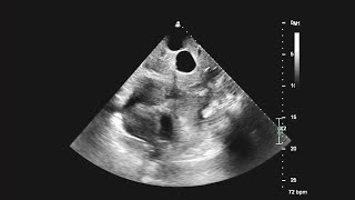 Pericardial Tamponade With Echo Contrast Confirmation of Pericardial Catheter Placement [upl. by Aitel]