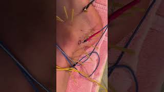 Ankle Pain Peroneus Tendon Dry Needling with Electrical Stimulation dryneedlingtherapy anklepain [upl. by Aronoh]