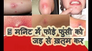 5 मिनट में फोड़े फुंसी को जड़ से ख़त्म करने का घरेलु उपायBoils Treatment by health and beauty [upl. by Napoleon]