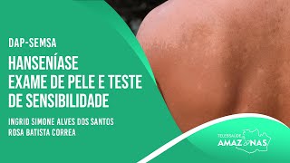 SEMSA  HANSENÍASE  EXAME DE PELE E TESTE DE SENSIBILIDADE [upl. by Oel388]