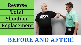 Reverse Total Shoulder Replacement Before amp After [upl. by Cissie769]