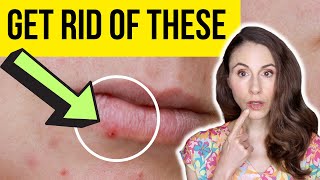 HOW TO GET RID OF LIP PIMPLES FAST  Dermatologist [upl. by Atnovart535]