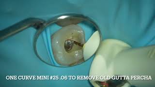 Endodontic retreatment with One Curve Mini [upl. by Niroc]