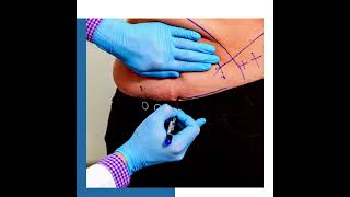 Bariatric Journey  What Is PostSurgery Body Contouring [upl. by Ttemme]