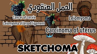 10 Sketchoma  pathology practical  Uterus leiomyoma  Carcinoma  vesicular mole [upl. by Pierre]