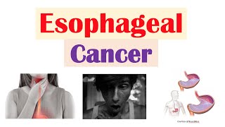 Esophageal Cancer  Risk Factors Pathogenesis Signs and Symptoms Diagnosis Treatment [upl. by Spindell]