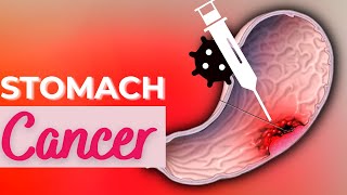 Stomach Cancer Causes Signs and Symptoms Diagnosis and Treatment [upl. by Derwin701]