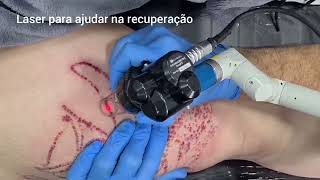 Remoção de Tatuagem com Anestesia Multiplos lasers associados a técnica equivale a 3 sessões em 1 [upl. by Undry]