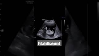 Fetal echocardiography ultrasoundAntenatal ultrasoundFetal echocardiography ultrasound [upl. by Jeno958]