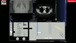 CT Pulmonary Angiography Full Process In Hindi  ctpulmonaryangio Radiologydept [upl. by Ulane841]