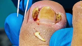 Infected Ingrown Toenail Left Untreated TOO LONG [upl. by Tisbe783]