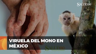 ✅ Casos de VIRUELA DEL MONO en México  Prevención y síntomas  Salud180 [upl. by Brett603]