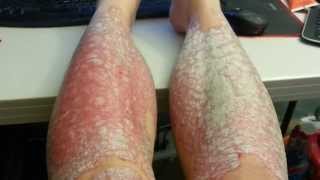 Psoriasis Scrape  Side by side comparison [upl. by Noeruat]