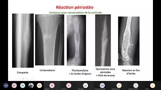 Radio  Tumeurs Osseuses et arthropathies non infectieuses [upl. by Thomasa]