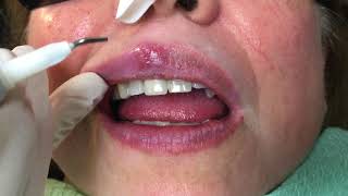 Houston Cosmetic DentistHow Lasers can Zap cold sores [upl. by Aikas706]