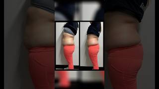 Results of cryoslimming cryotherapy cryoslimming cryotherapist [upl. by Ciri]