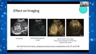 How Do You Get Those Images Optimization for CEUS Liver Mass [upl. by Nickelsen]