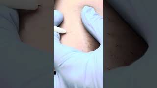 Relaxing electrolysis hair removal Zap hairs with me [upl. by Yunick]